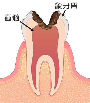 虫歯の後期