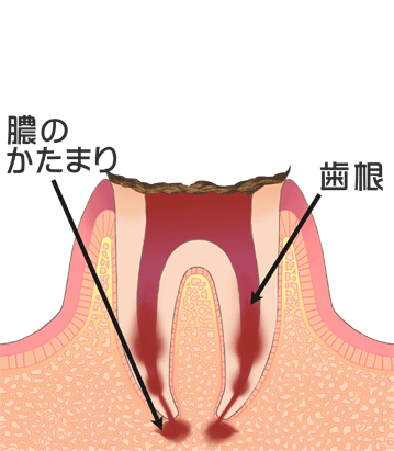 虫歯の末期